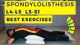 Anterolisthesis l5 s1 treatment spondylolisthesis l4l5 lumbar spine grade 1 in hindi Dr nayan [upl. by Lanita]