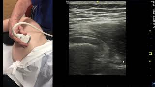 Ultrasound examination of the lateral hip [upl. by Silvain]