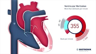 Ventricular Fibrillation V Fib amp Sudden Cardiac Death [upl. by Towny]