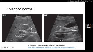 Ecografía de colédoco [upl. by Tigirb]