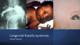 Congenital Rubella Syndrome Early and Late Onset Manifestations [upl. by Rima]