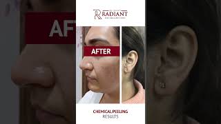 Chemical Peel  Skin Treatment  Radiant Skin Hair Laser amp ENT Clinic [upl. by Rodolph]