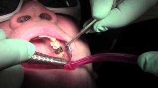 Canker sore treatment and relief at Sana Dental in Edmonton [upl. by Dumas450]