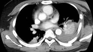 Pulmonary hemorrhage A Ahuja AT et al 2017 Book Essential Radiology [upl. by Htabmas]