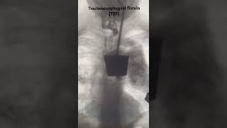 A tracheoesophageal fistula TEF radiology paediatric clinical neetpg [upl. by Berkman391]