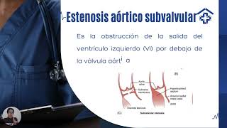 Estenosis aóticaecocardiografía [upl. by Bertrando]