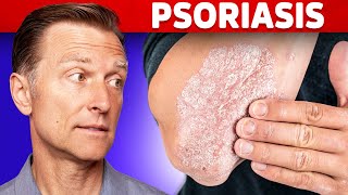 Psoriasis Treatment – The Best 3 Remedies for Psoriasis – DrBerg [upl. by Ignatius]