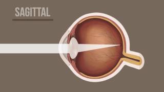 Presbyopia Animation [upl. by Rats]