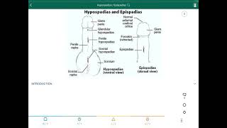 Hypospadias  Epispadias  فتحة الأحليل السفلية  فتحة الأحليل العلوية [upl. by Jamison795]