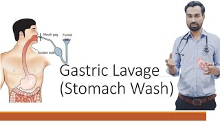 GASTRIC LAVAGE STOMACH WASH STOMACH IRRIGATION ICU PROCEDURE DR SALMAN NASIR [upl. by Suiravat]