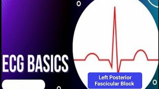 ECG Basics  Left Posterior Fascicular Block ECG Criteria and Electrophysiology of LPFB [upl. by Weitzman967]