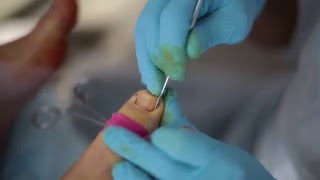 Ingrown toenail surgery  Partial Nail Avulsion [upl. by Charbonneau]