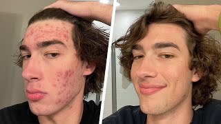 my struggles with acne [upl. by Atiker]