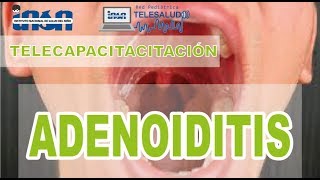 Adenoiditis  Telecapacitación INSN [upl. by Bigelow278]