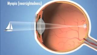 Four Main Types of Refractive Error vision problems  Eye Associates [upl. by Lipson]