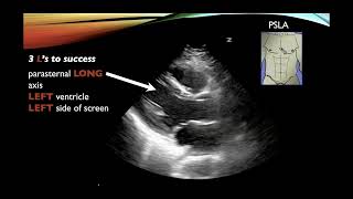 Basic Cardiac Ultrasound Views and Pathology  Echocardiography [upl. by Nitsirc37]