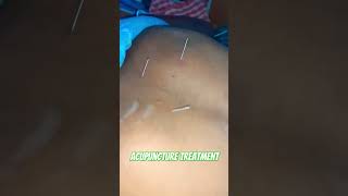 Acupuncture treatment for back pain and shoulder pain [upl. by Zumstein]