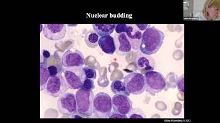 WHO Classification of Myelodysplastic Syndromes [upl. by Bekha]