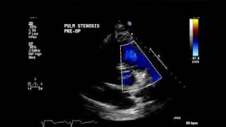 Moderate Pulmonary stenosis [upl. by Aehsa]