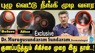 🔥இனி முடி கொட்டாது வளரும்🔥  Treatment for Alopecia Areata  Puluvettu doctor360 alopecia [upl. by Euqinomahs715]