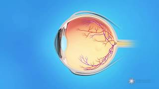 What causes a retinal tear or detachment [upl. by Ronda]