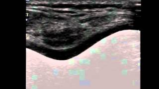 Musculoskeletal Ultrasound Knee 6 Suprapatellar Transverse Scan in Maximal Flexion [upl. by Tocs]