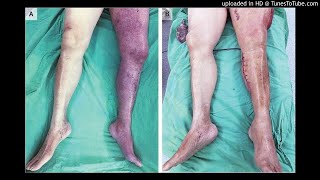 Phlegmasia Cerulea Dolens with Compartment Syndrome [upl. by Enelyak]