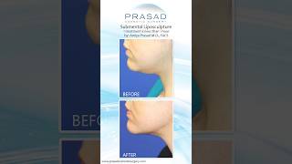 Safe Double Chin Removal in One Treatment Session doublechin [upl. by Roberta]