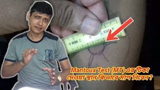 How to measure of Mantoux Test MT vaccine [upl. by Blancha]