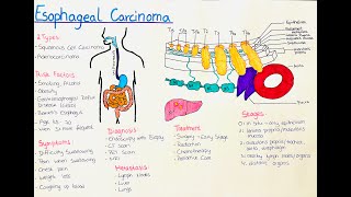 Esophageal Cancer  What you need to know [upl. by Gile]