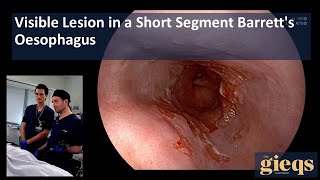 Visible Lesion in a Short Segment Barretts Oesophagus [upl. by Ecertal26]