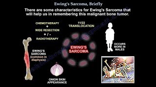 Ewings Sarcoma Briefly  Everything You Need To Know  Dr Nabil Ebraheim [upl. by Remliw]