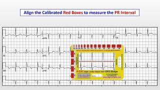 EKG Concepts  Interpreting 12Lead EKGs with RCAT EKG Badge  Case  7 [upl. by Zamir]