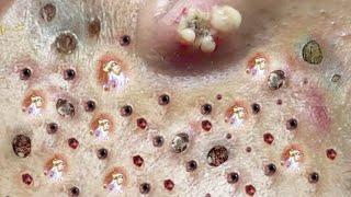 Blackhead Removal With Sac Dep Spa 100074051 [upl. by Darn]