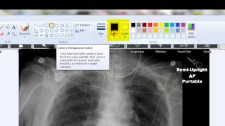 Removing Patient Info from Radiographs [upl. by Cloots695]