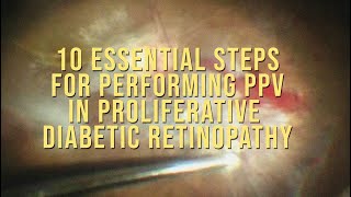 10 steps to follow in PDR surgery [upl. by Ingvar]