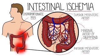 Intestinal Ischemia  Mesenteric Ischemia Acute amp Chronic amp Ischemic Colitis [upl. by Renfred]