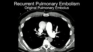 Recurrent Pulmonary Embolism [upl. by Gertrud]