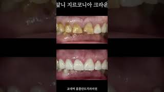 앞니 지르코니아 크라운 Zirconia Crown 앞니크라운깨진앞니앞니교모앞니마모앞니파절zirconiacrown [upl. by Evol]