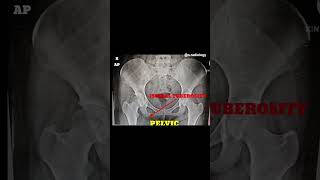 Anatomy of pelvic x ray radiology shortvideo [upl. by Annayoj]