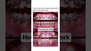 How Braces Work TimeLapse of Teeth Alignment  Daily Dentists [upl. by Taggart982]