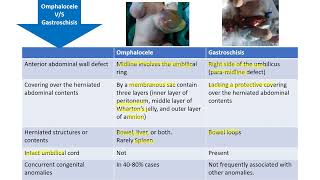 Omphalocele vs Gastroschisis  Spot Diagnosis  6  Pediatrics [upl. by Ycniuq]