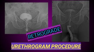 Retrograde Urethrogram Procedure  X ray Urethrogam  Urine Blockage [upl. by Airemat]