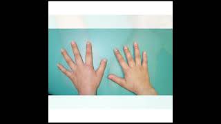 Brachydactyly Treatment  Symptoms and Causes  Diagnosis  Prevention health [upl. by Wardle]