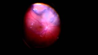 choroidal tumor biopsy [upl. by Burnaby]