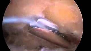 Arthroscopic Subacromial Decompression [upl. by Necaj]