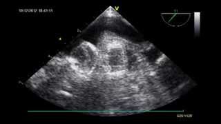 LEFT ATRIAL APPENDAGE CLOSURE PROCEDURE  Role of Transesophageal Echocardiography [upl. by Sadonia]