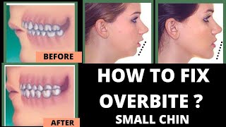 HOW TO FIX OVERBITE amp Small chin  WITH NO BRACES [upl. by Barry579]