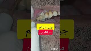 ازالة وتنظيف جير و تقليح الاسنان dentist stitch اكسبلور stitchlover ترند [upl. by Saunderson273]