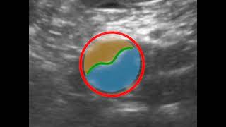 Aortic Dissection  Short Axis [upl. by Anirdnaxela]